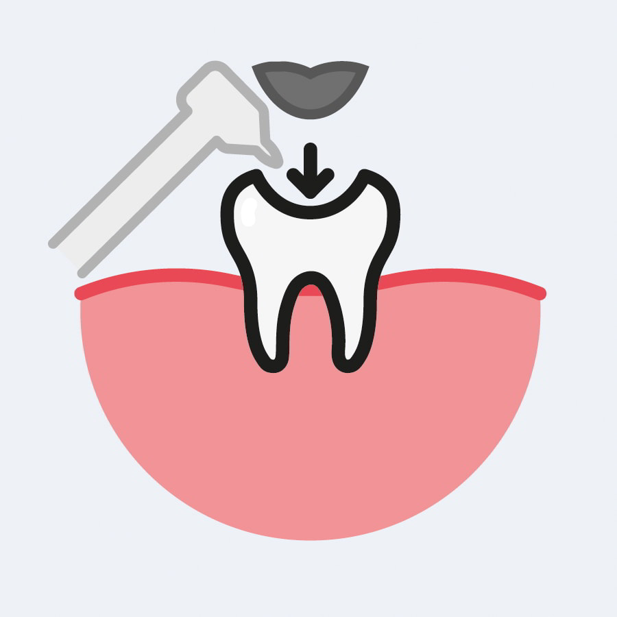 Amalgam Filling