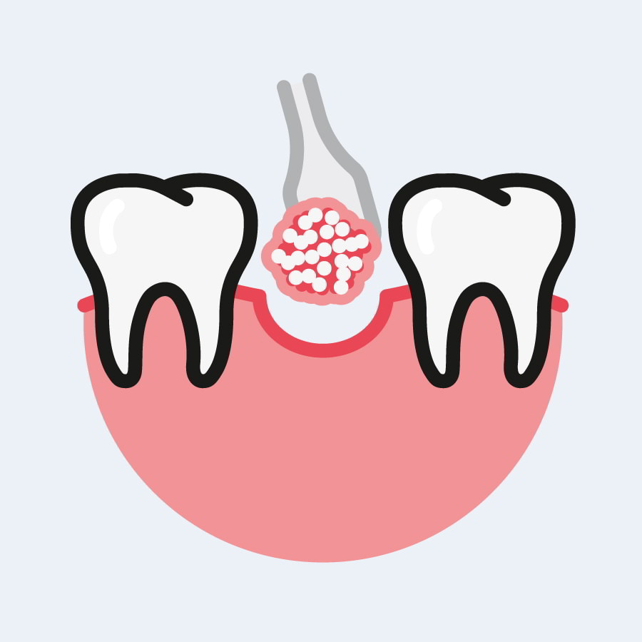 Bone Grafting