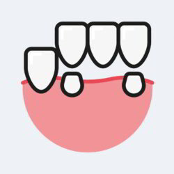 Dental Bridge