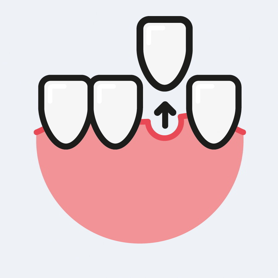 Dental Extractions