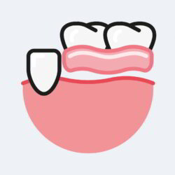 Partial Dentures