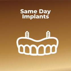 Full Arch Implants