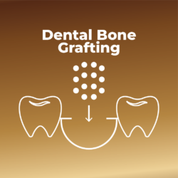 Dental Bone Grafting