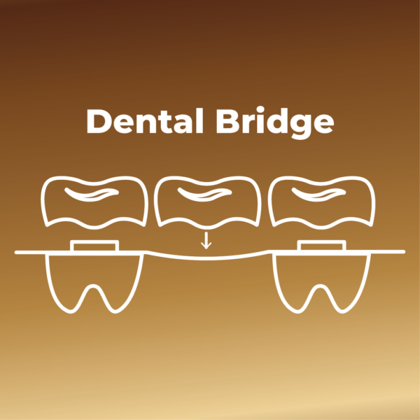 Dental Bridge