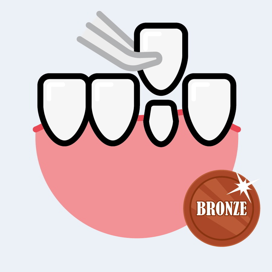 Veneers - Bronze