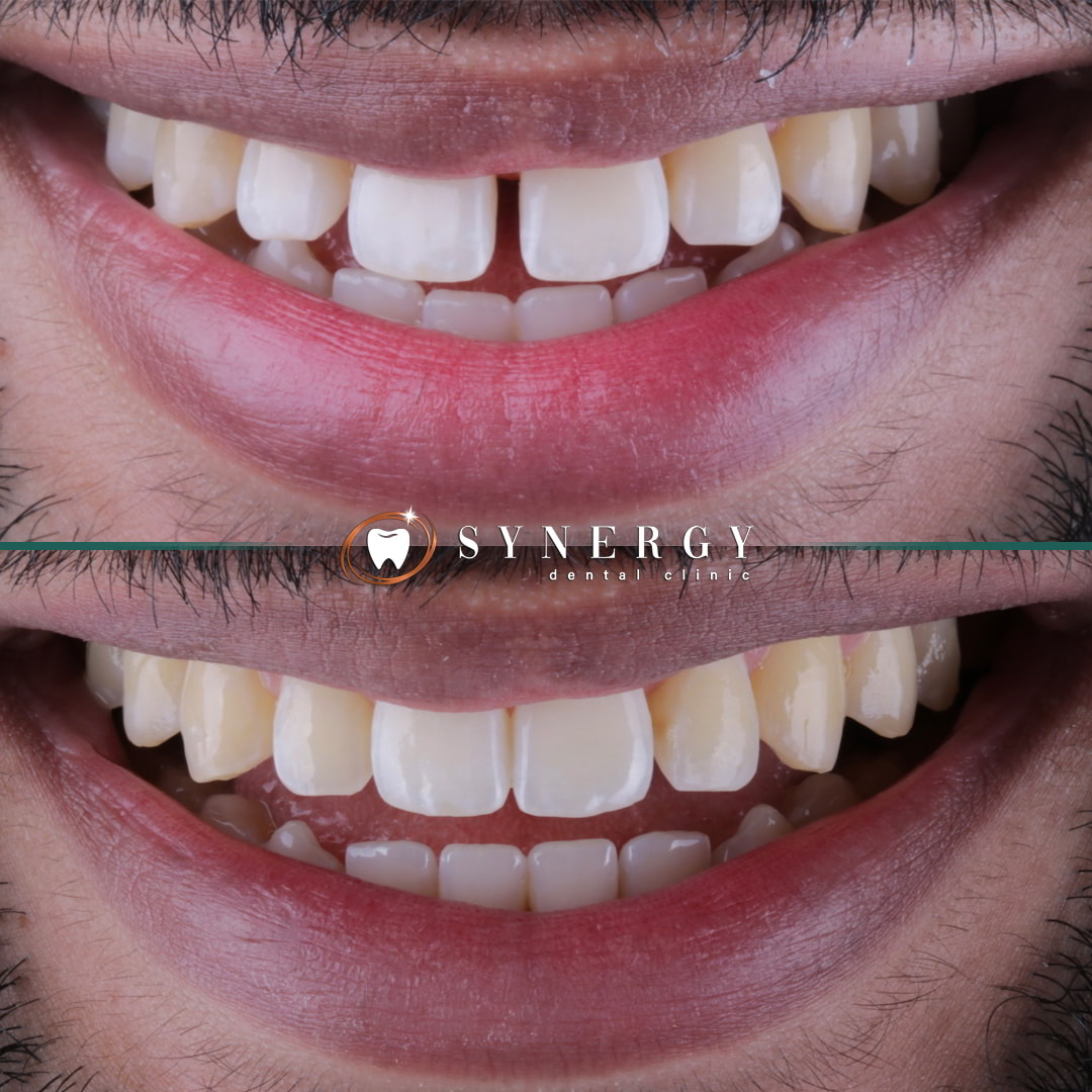 Dr. Mo Patel - Synergy Bolton - Invisalign