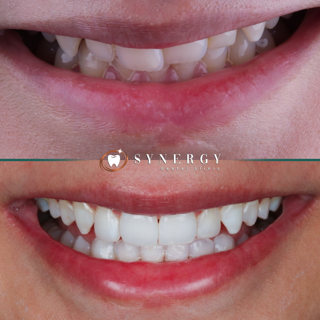 Dr. Mo Patel - Synergy Bolton - Invisalign