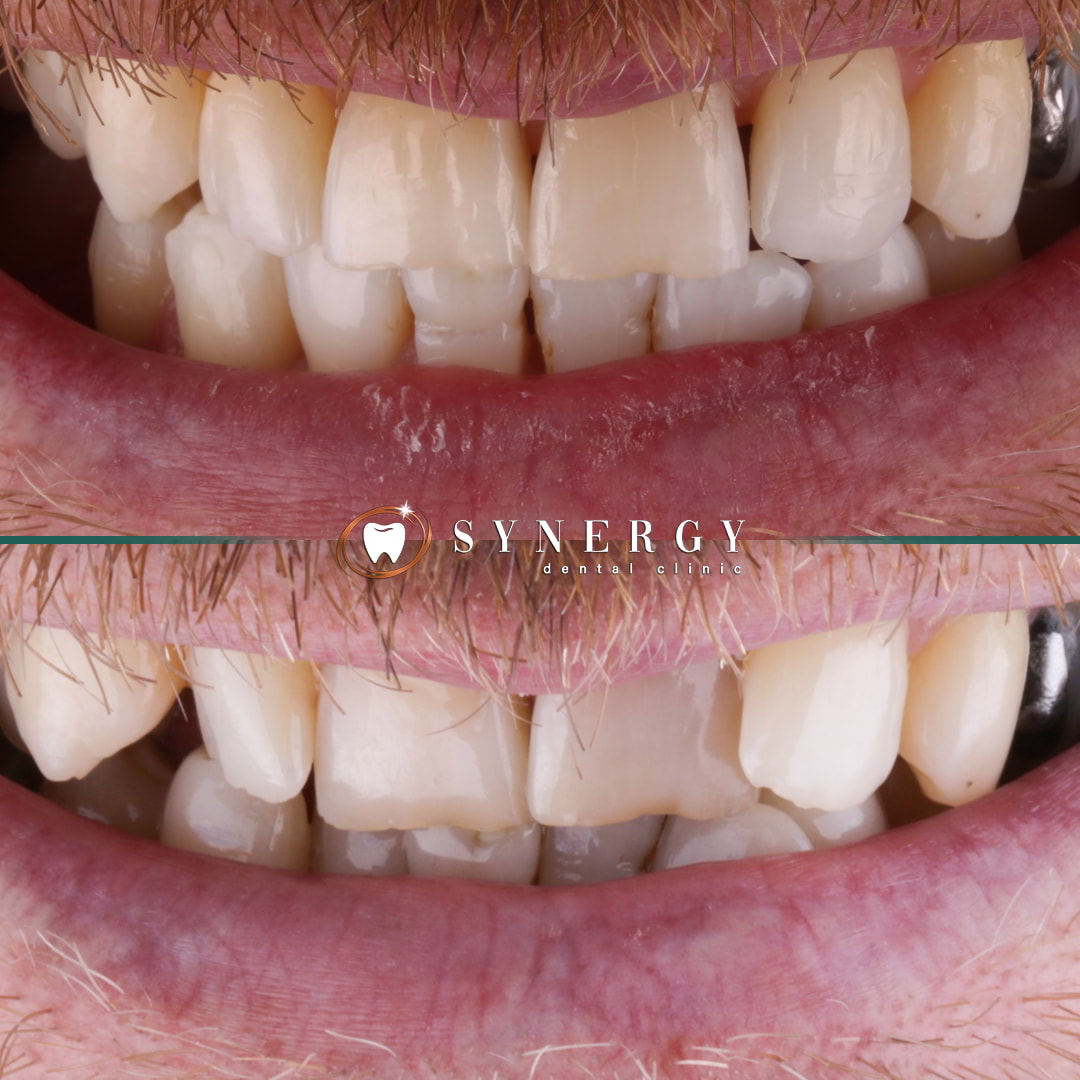 Dr. Mo Patel - Synergy Bolton - Invisalign