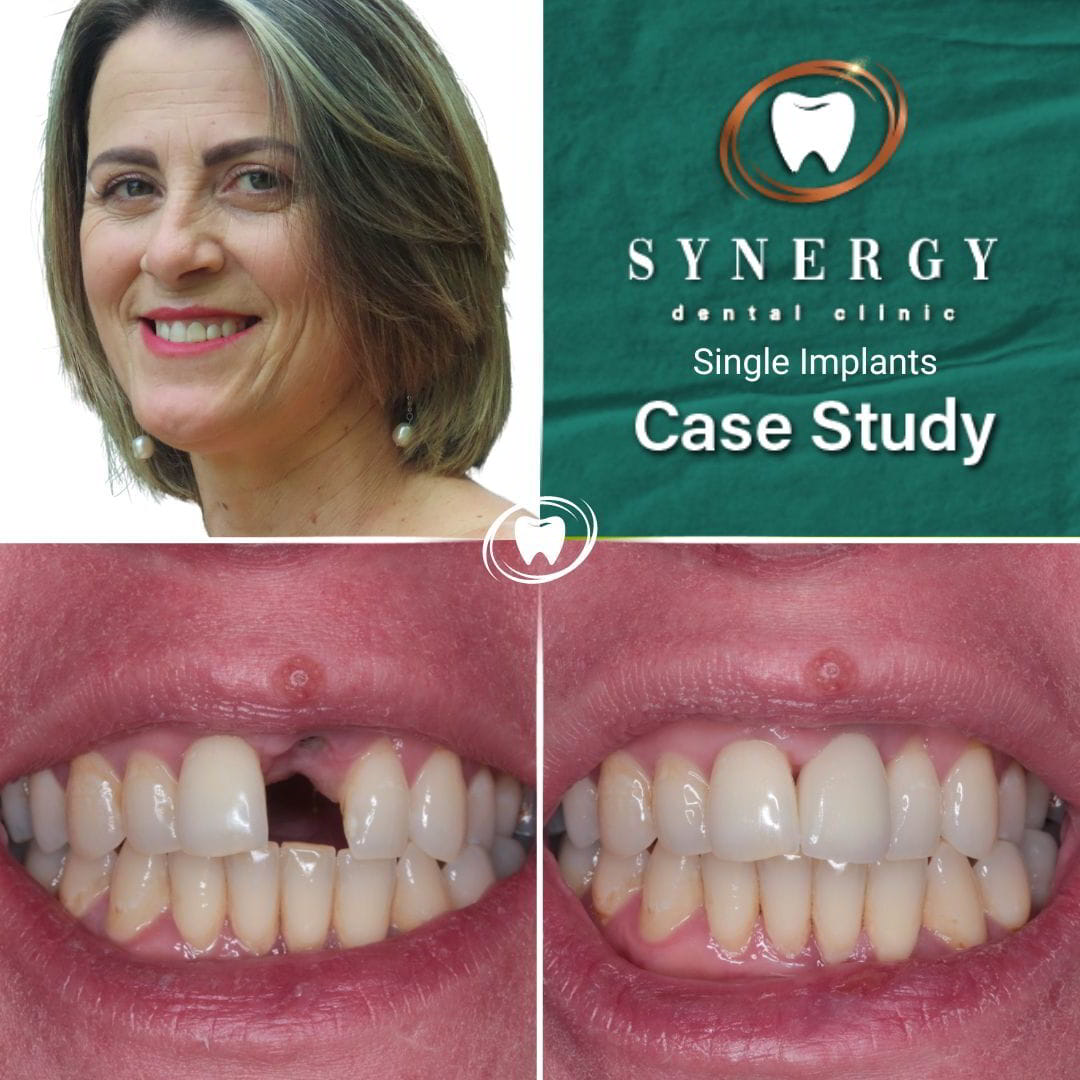 Dr. Zuber Bagasi - Synergy Blackpool - Single implant 5