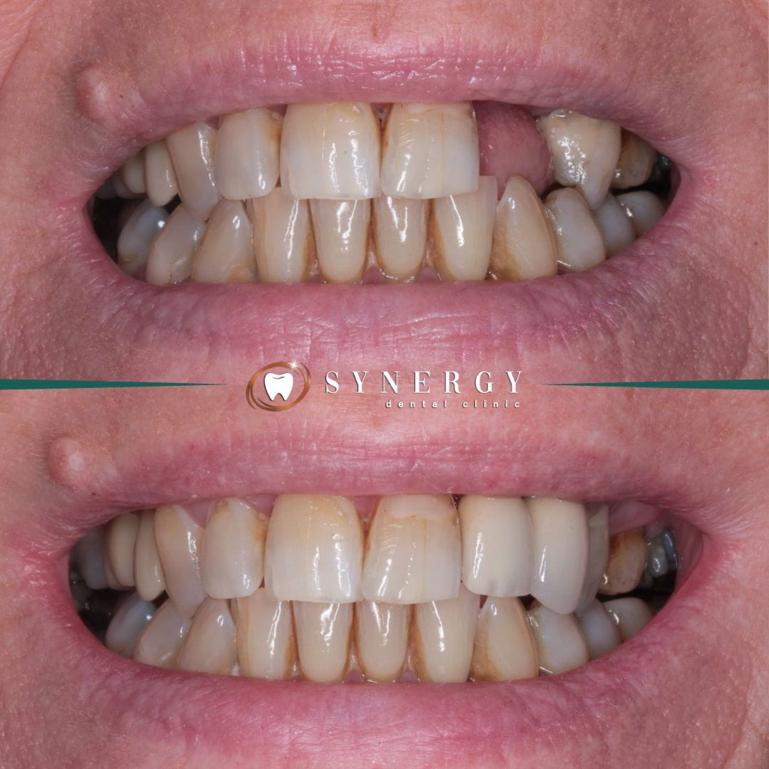 Dr. Zuber Bagasi - Synergy Blackpool - Single implant