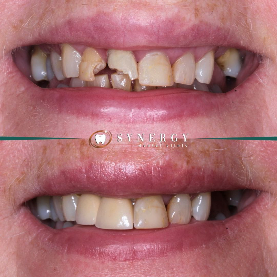 Dr. Zuber Bagasi – Synergy Blackpool – Single implant