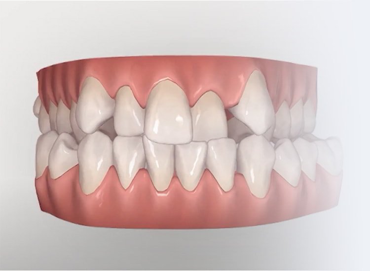 Initial Invisalign scan