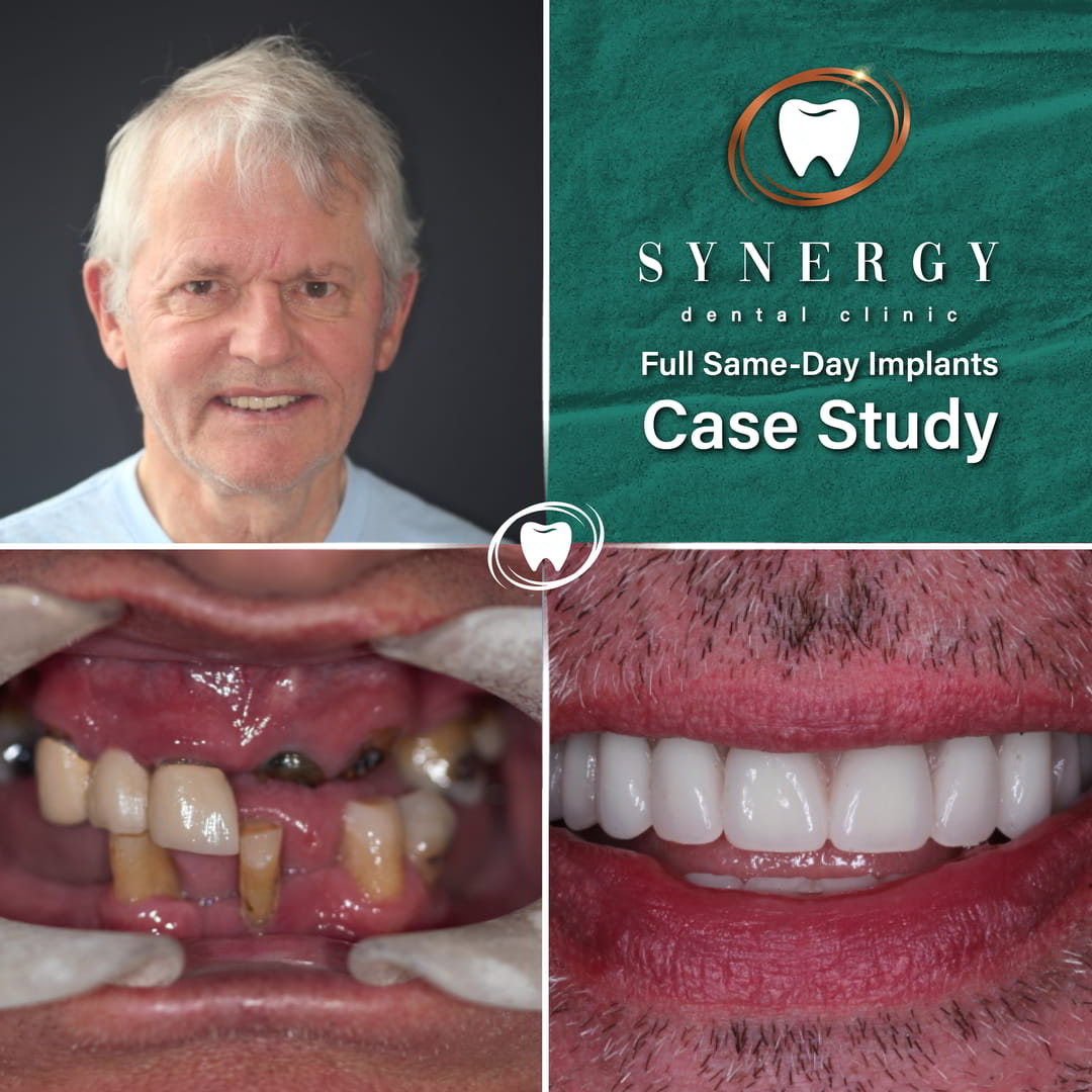 Same day implants - Zuber bagasi- Synergy Dental Blackpool